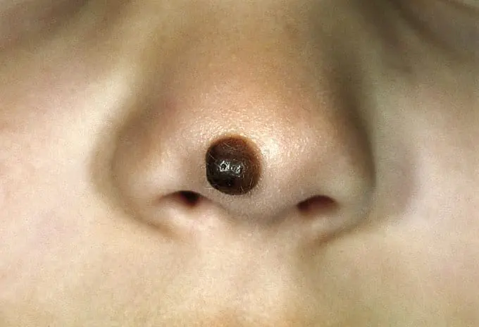 Mole removal – Which is the best way?