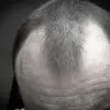 hair loss