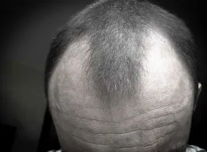 hair loss