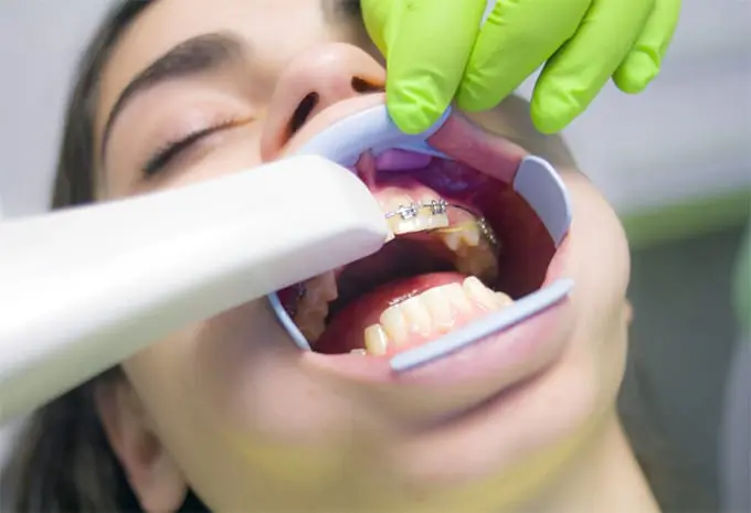 What Teeth Whiteners Really Do to Your Teeth