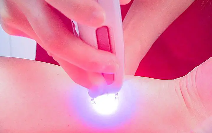 Laser Hair Removal