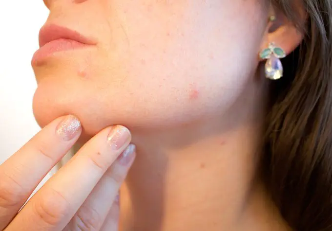 What are the top-recommended skincare ingredients to fight Rosacea?