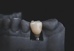 Dental Implant Dentist: