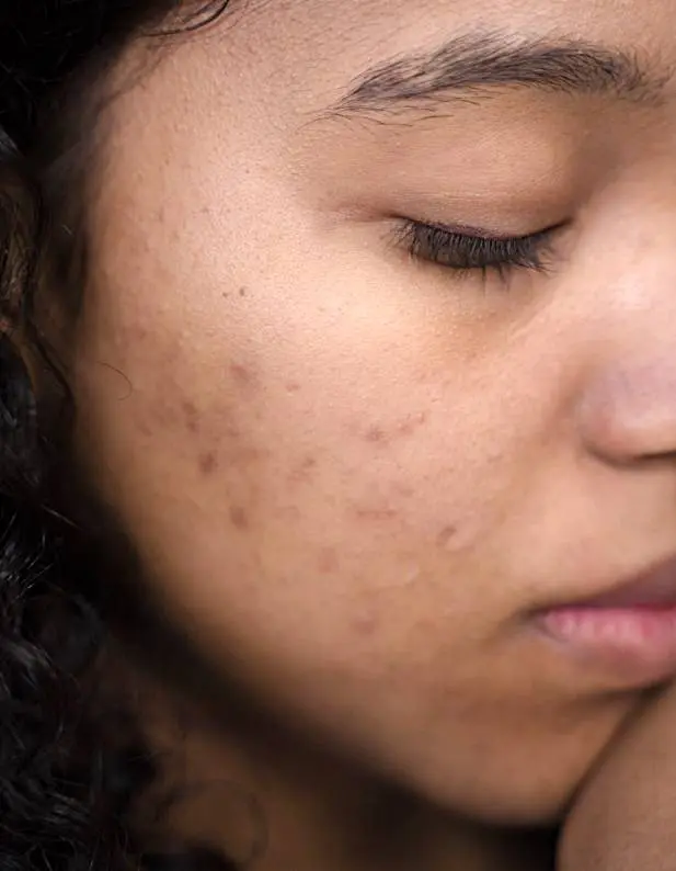 Manage Acne Scarring tips