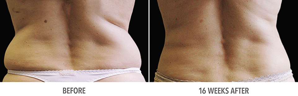 what is coolsculpting
