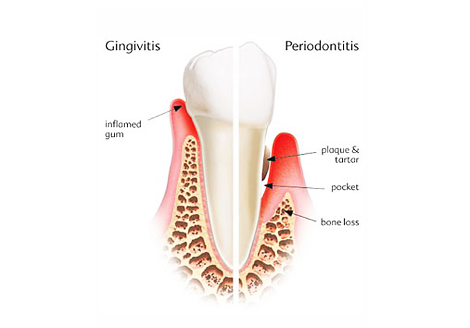 gum disease Alzheimer’s