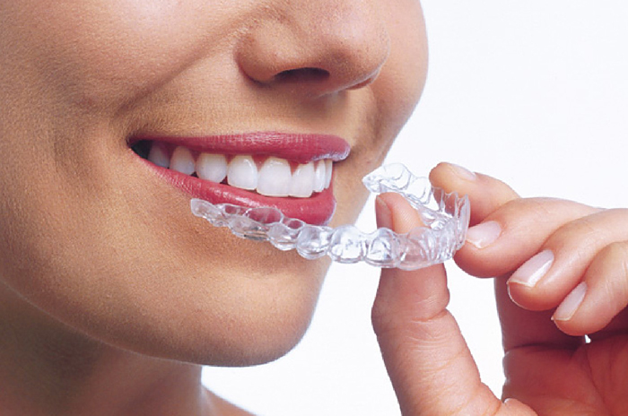 Clear Aligners