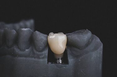 Dental Implant Dentist: