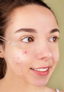 Manage Acne Scarring
